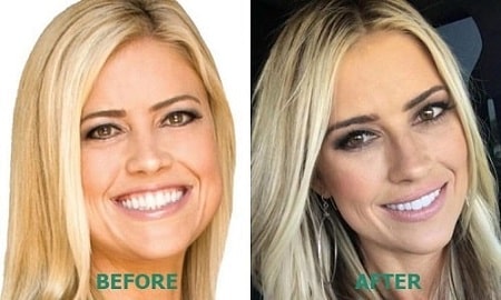 A before and after picture of Christina el Moussa showing her changing lips,